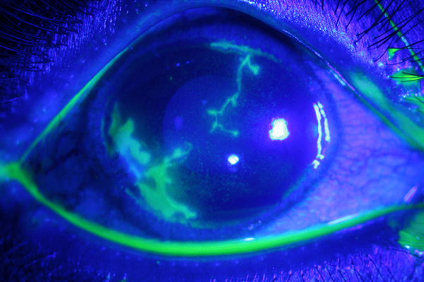 Does COVID-19 affect the eyes?